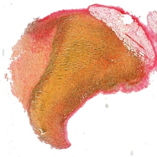 Exploring immunotherapy drug-combination and their impact on cancer