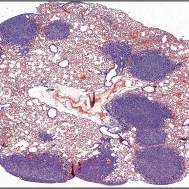 Host response to chemotherapy supports pulmonary metastasis in part due to the formation of pre-metastatic niche